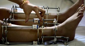 LIMB LENGTHENING SURGERIES IN INDIA TO BECOME TALLER